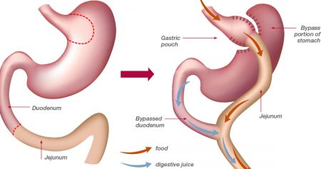 Гастропарез желудка. Бариатрия шунтирование желудка. Желудочное шунтирование (gastric Bypass). Мини гастрошунтирование желудка.